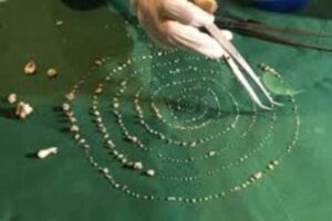 Menino de 7 anos tem 526 dentes retirados em cirurgia na Índia