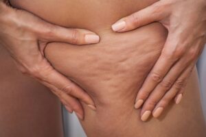 Antioxidantes, estes alimentos hidratam e ajudam a reduzir a celulite