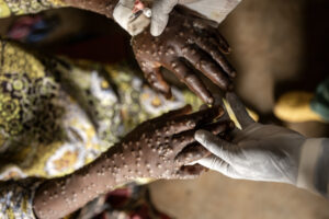 África registra quase 50 mil casos de Mpox confirmados