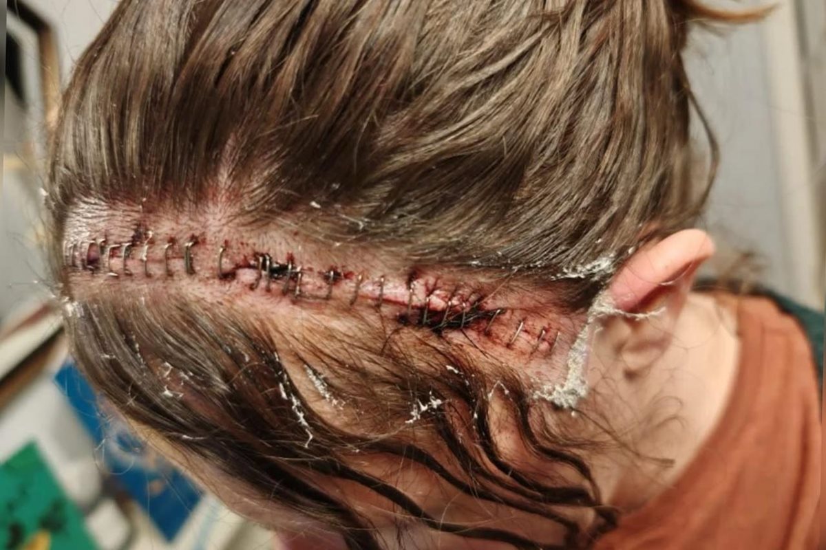 Com dor de cabeça frequente, mulher descobre tumor cerebral de 15 anos