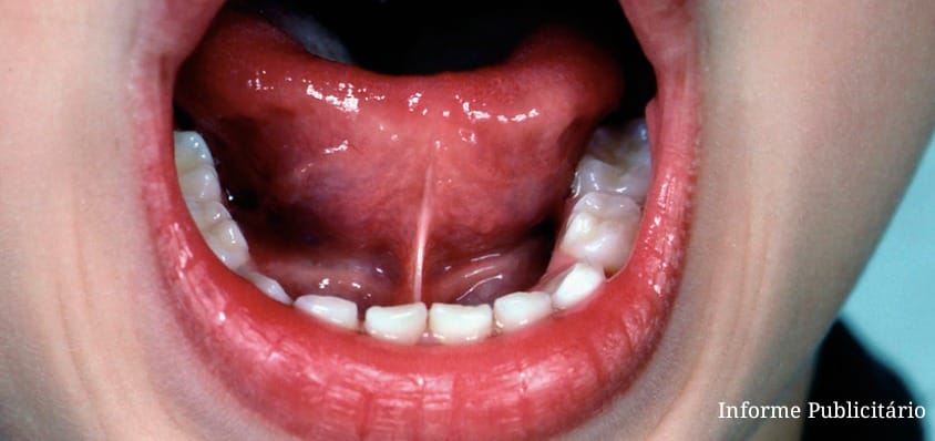 Cirurgia de frenectomia chega à UBS Tinga a partir da próxima semana