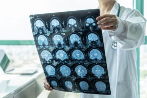 Saúde: Síndrome de Guillain-Barré: o que é, sintomas, causas e tratamento