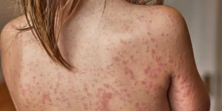 Brasil intensifica vigilância contra sarampo após surto nos EUA